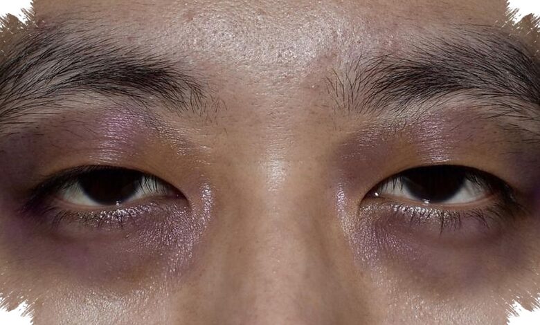 Jangan Abaikan Mata Seperti Dibogem, Ini 5 Penyebab Raccoon Eyes yang Perlu Diwaspadai